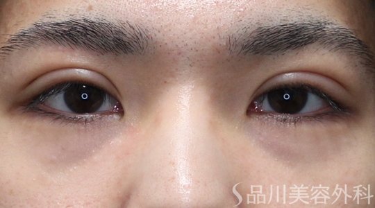 症例NO.74778のAFTER写真