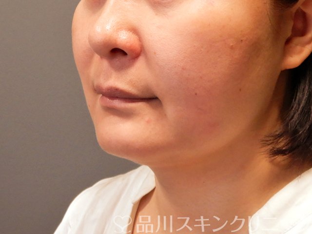 症例NO.70314のAFTER写真