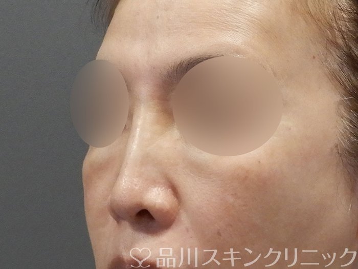 症例NO.75044のAFTER写真