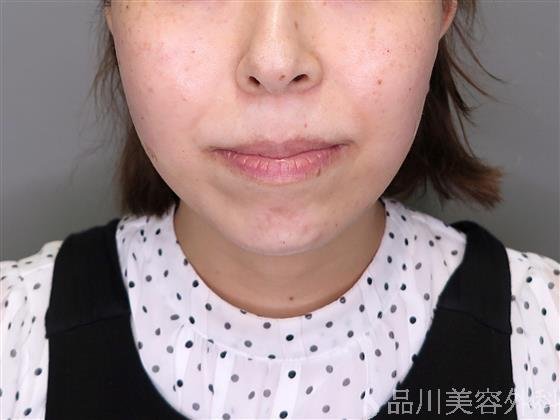 症例NO.48150のAFTER写真
