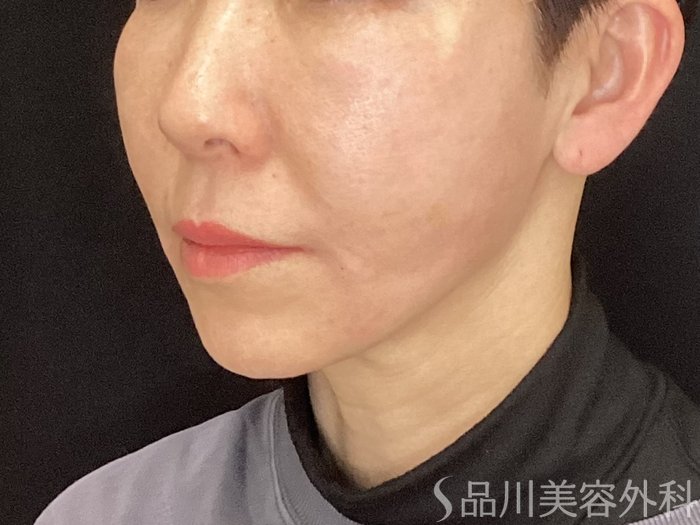 症例NO.72902のAFTER写真