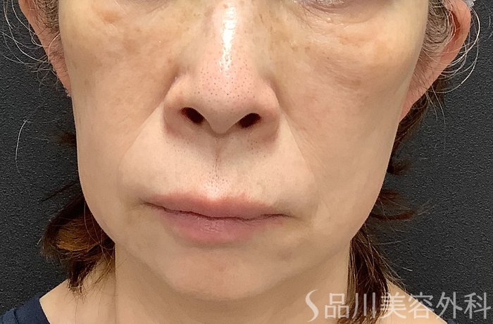症例NO.75048のBEFORE写真