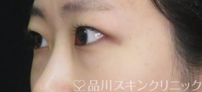 症例NO.74860のBEFORE写真