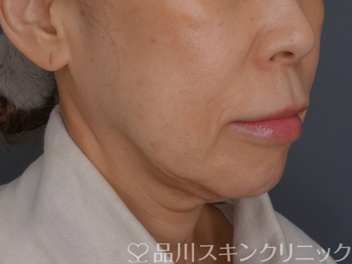 症例NO.72448のBEFORE写真