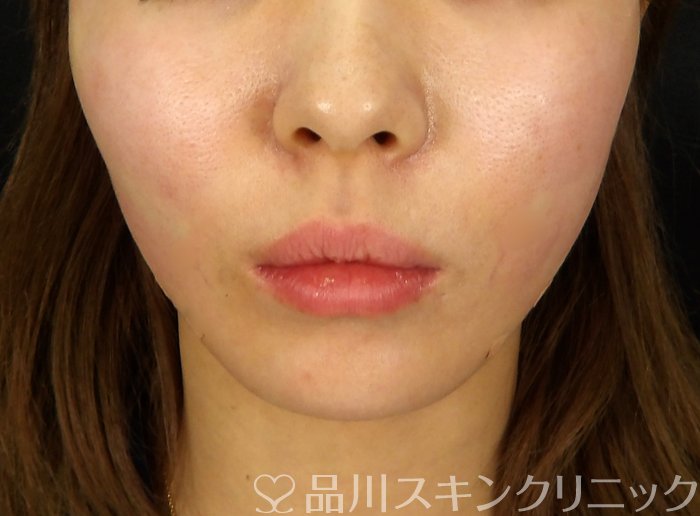 症例NO.72637のAFTER写真