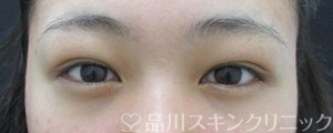 症例NO.74520のBEFORE写真