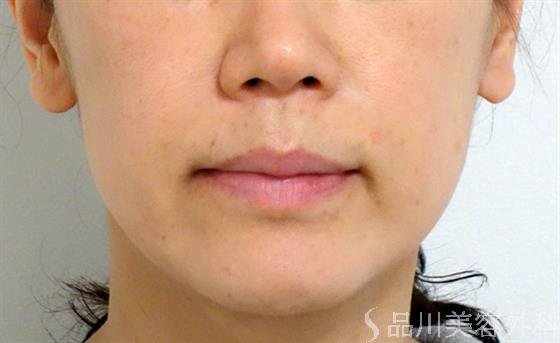 症例NO.28141のBEFORE写真