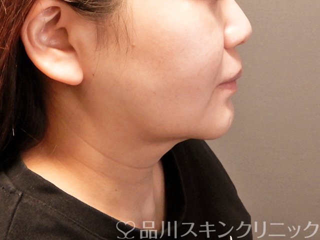症例NO.69394のBEFORE写真