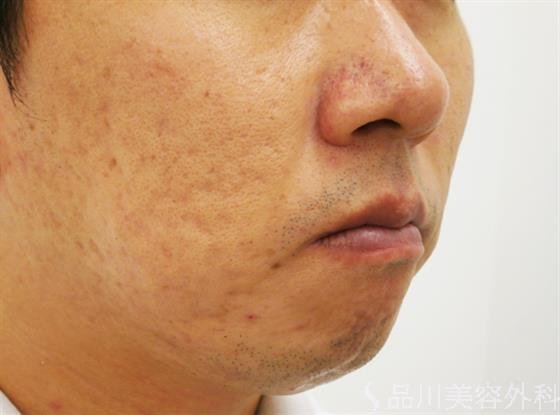 症例NO.30849のBEFORE写真