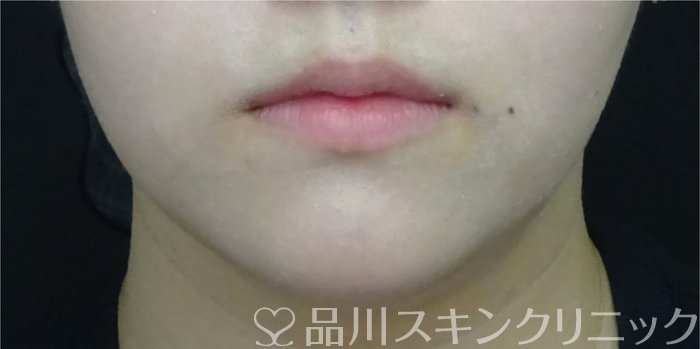 症例NO.71993のBEFORE写真