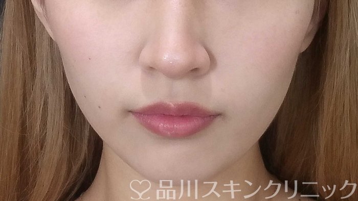 症例NO.71640のBEFORE写真