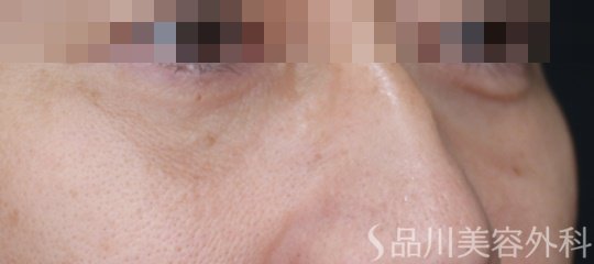 症例NO.71429のAFTER写真