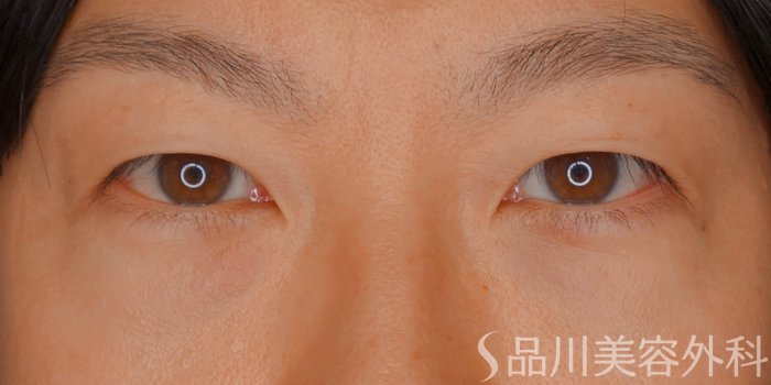 症例NO.73727のAFTER写真