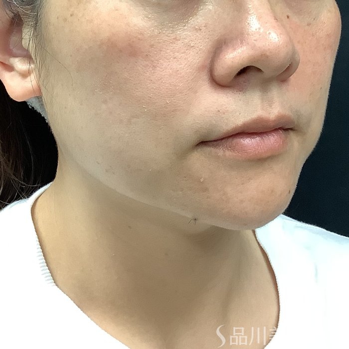 症例NO.75346のBEFORE写真
