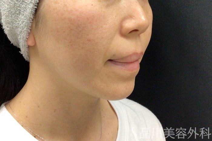 症例NO.71279のBEFORE写真