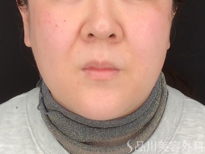 症例NO.64878のBEFORE写真