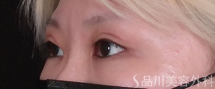 症例NO.70952のAFTER写真