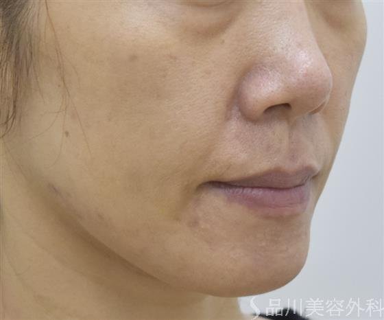 症例NO.54260のBEFORE写真