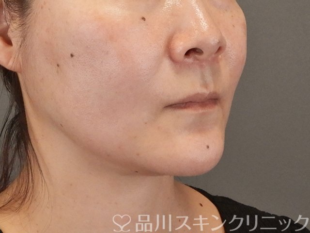 症例NO.75317のAFTER写真