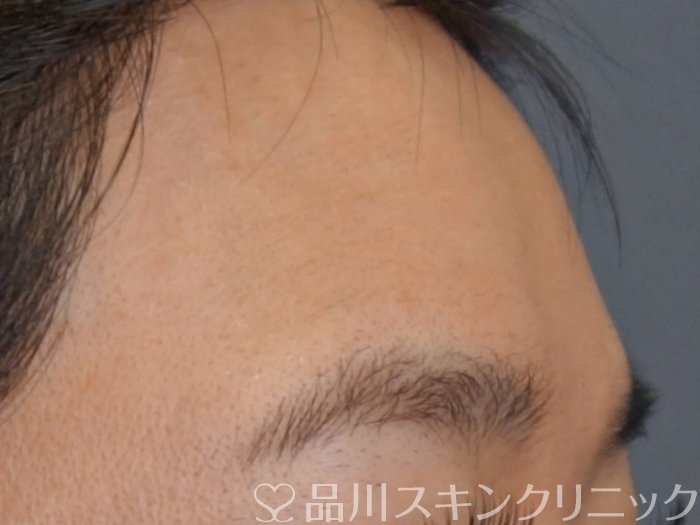 症例NO.73444のBEFORE写真