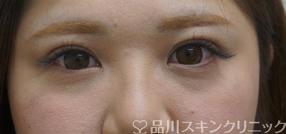 症例NO.40449のAFTER写真