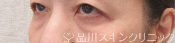 症例NO.70229のBEFORE写真