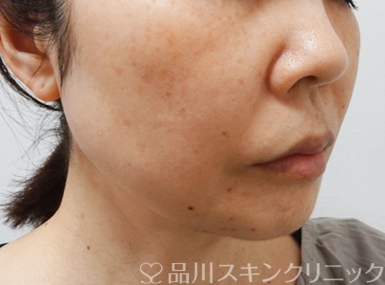 症例NO.70674のAFTER写真