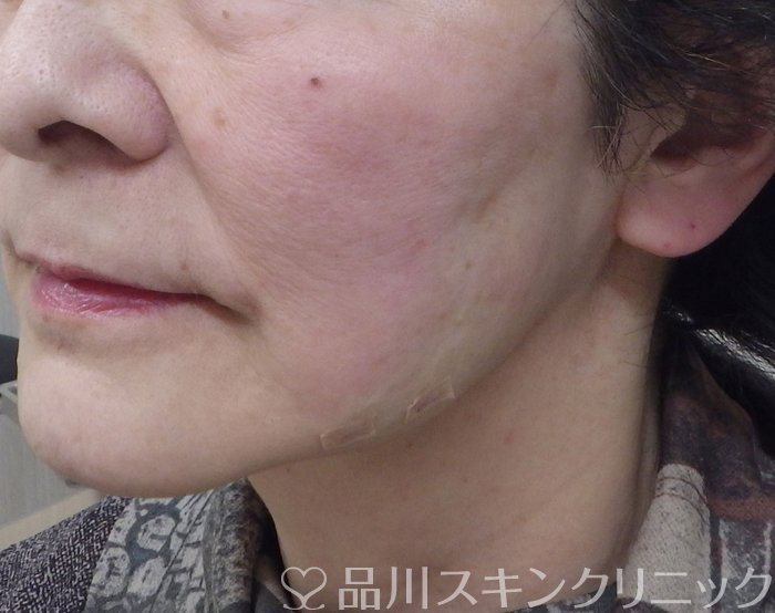 症例NO.69343のAFTER写真