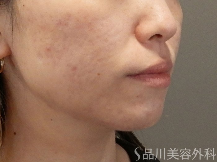 症例NO.71675のAFTER写真