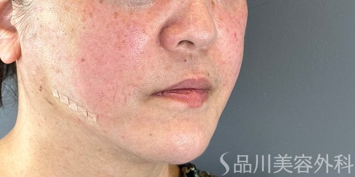 症例NO.72413のAFTER写真