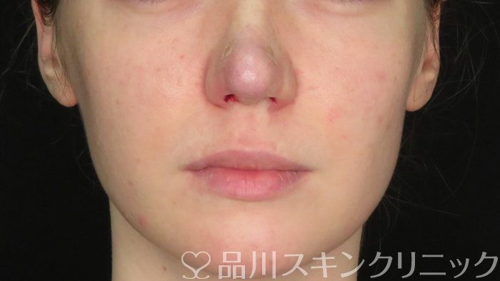 症例NO.71268のAFTER写真
