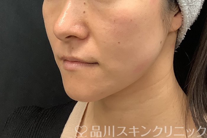 症例NO.71545のBEFORE写真