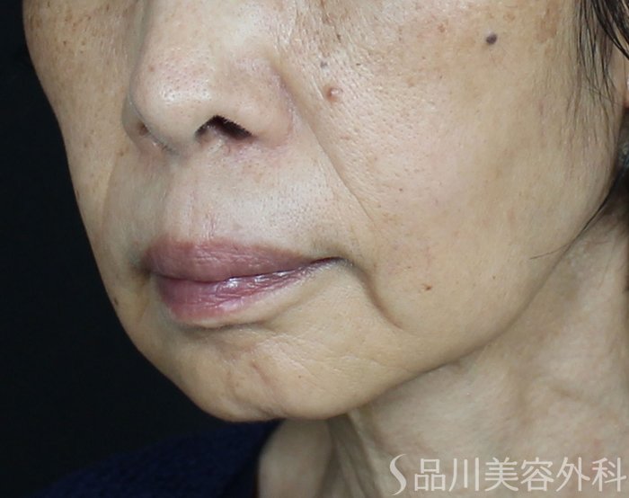 症例NO.69622のBEFORE写真