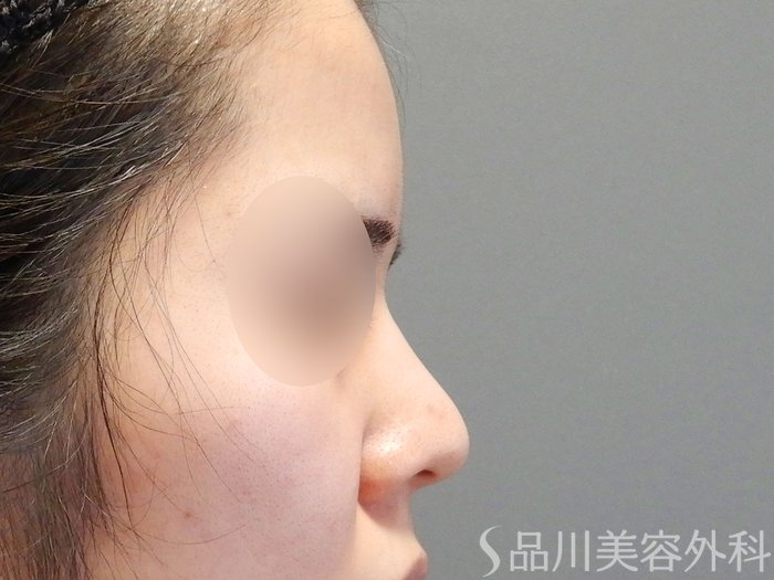 症例NO.71066のBEFORE写真