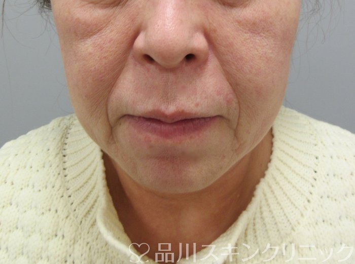 症例NO.69824のBEFORE写真