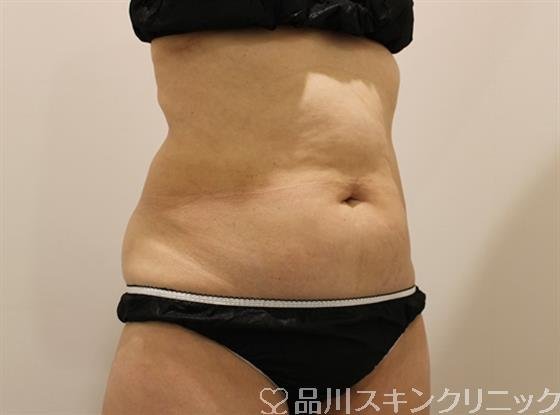 症例NO.46751のAFTER写真