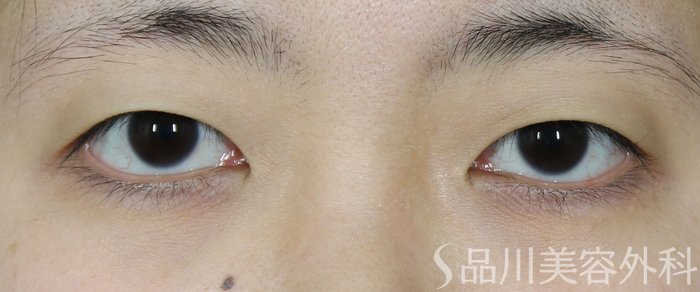 症例NO.72087のBEFORE写真