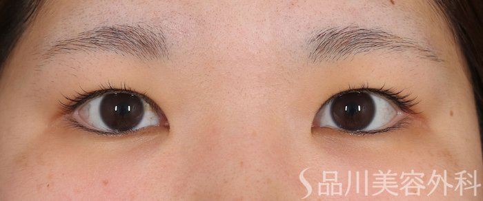 症例NO.73784のBEFORE写真