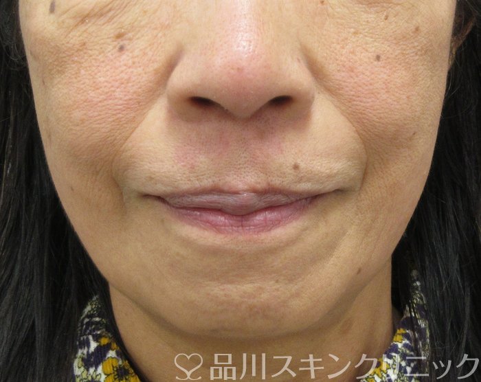 症例NO.75331のBEFORE写真