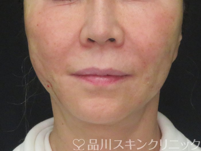 症例NO.73162のAFTER写真