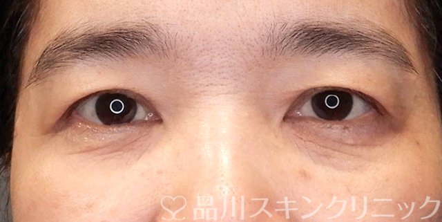 症例NO.67490のBEFORE写真