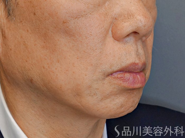 症例NO.73357のBEFORE写真