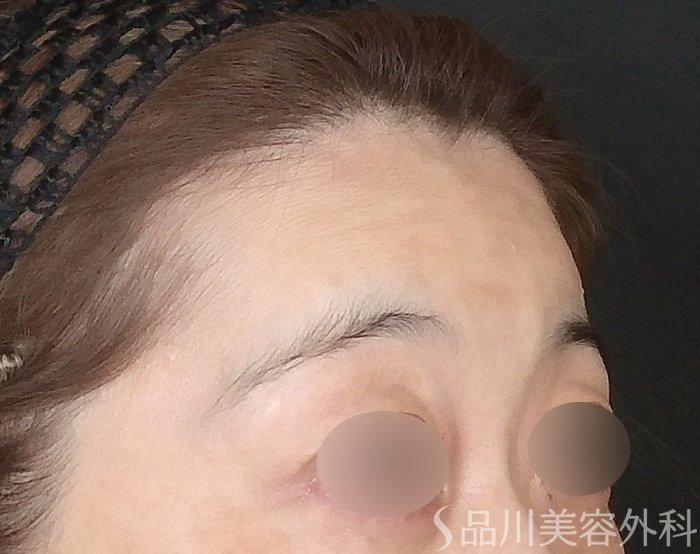 症例NO.70428のBEFORE写真