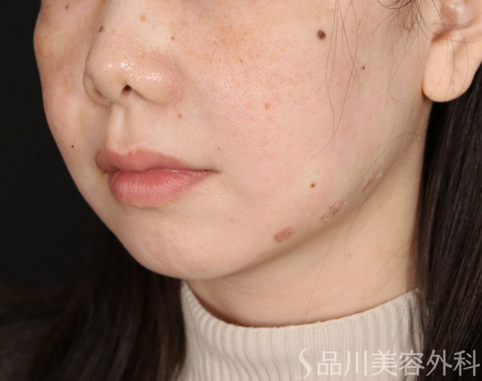 症例NO.72039のAFTER写真