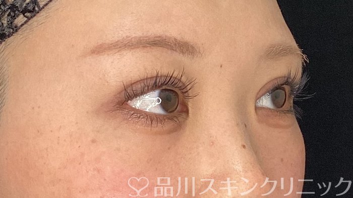 症例NO.75394のAFTER写真