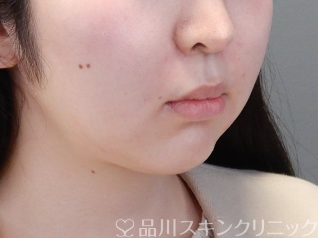 症例NO.68685のAFTER写真