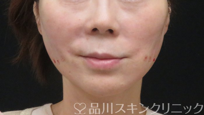 症例NO.72886のAFTER写真