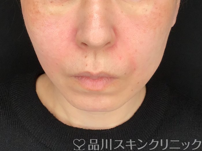 症例NO.64928のAFTER写真