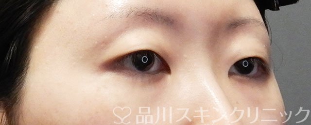 症例NO.73381のBEFORE写真