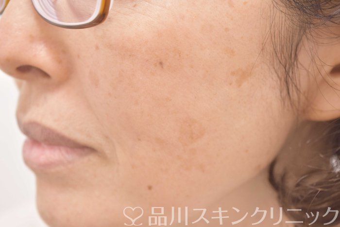 症例NO.64711のBEFORE写真